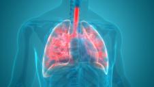 Pneymonia